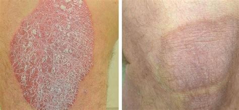 Pictures Of Plaque Psoriasis On Legs Symptoms And Pictures