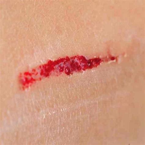 Come riconoscere e curare una ferita infetta - 7 passi