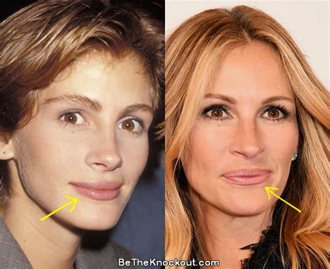 Julia Roberts Plastic Surgery Comparison Photos