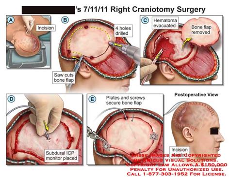 Amicus Illustration Of Amicus Surgery Craniotomy Skull Bone Incision Saw Flap Hematoma Evacuated