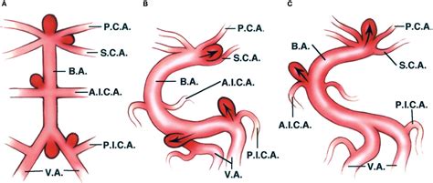 Aneurysms The Neurosurgical Atlas By Aaron Cohen Gadol Md