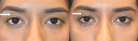 Eye Asymmetry Surgery And Treatment Fix Uneven Eyes