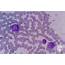 Plasma Cell Leukemia Manifestation In Peripheral Blood 2