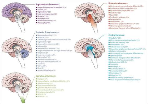 Manifestations Of Brain Tumors Based On Location Glioma Brain Tumor