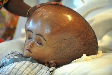 Watch The Amazing Journey Of A Baby Born With Swollen Head West