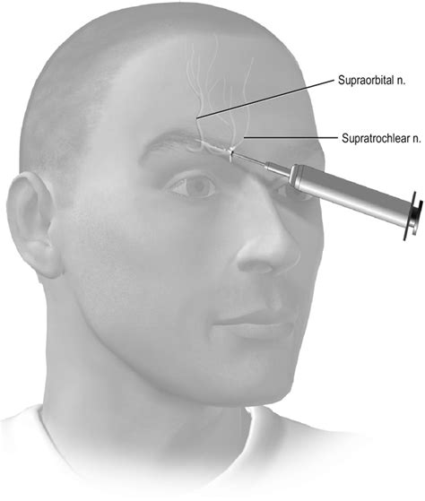 Figure 3 From Nerve Blocks In The Treatment Of Headache Semantic Scholar