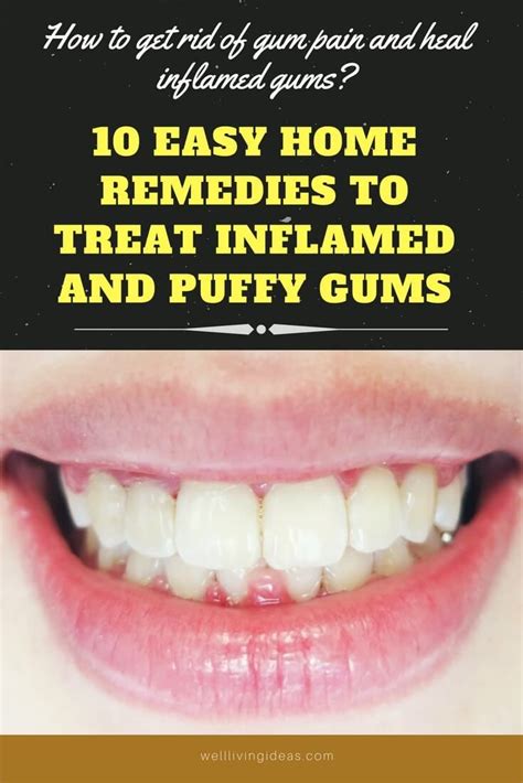 10 Best Home Remedies To Reduce Gum Swelling Swollen Gums Remedy Gum
