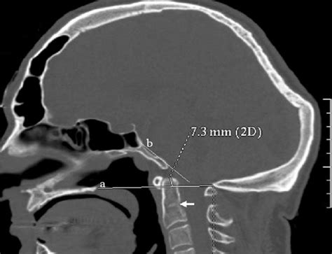 A Sagittal Ct Scan Showed Assimilation Of The Entire Anterior Arch Of