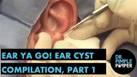 Ear Ya Go 👂🏽ear Cyst Compilation Part I Dr Pimple Popper