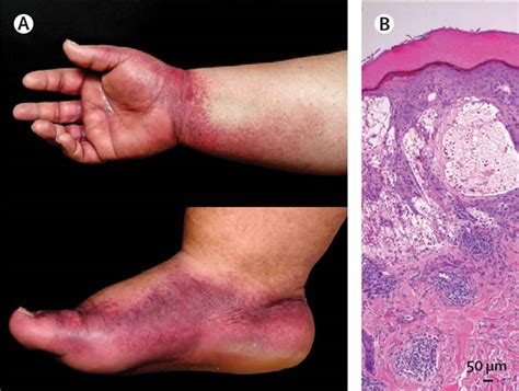 Papular Purpuric Gloves And Socks Syndrome Causes Symptoms Diagnosis