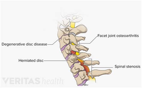 Conditions That May Occur In The Cervical Spine Cervical Vertebrae