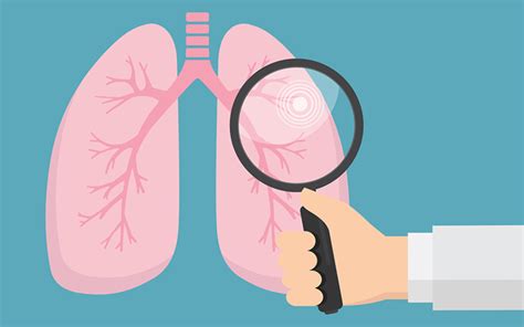 Should I Get A Lung Cancer Screening Cedars Sinai