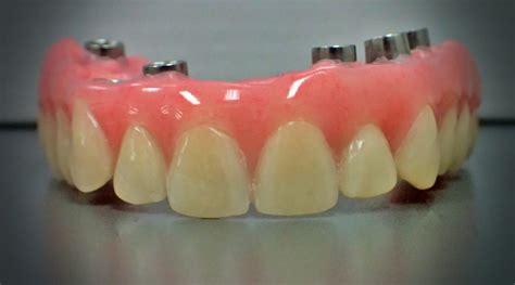 Fixed Implant Retained Hybrid Dentures Procare Denture Clinic