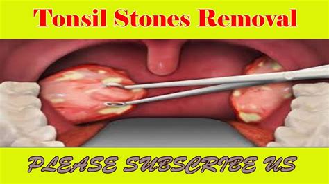 Tonsil Stones Removal How To Successfully Remove Tonsil Stones Youtube
