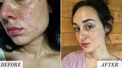 I Quit Drinking Alcohol And Improved My Skin Before And After Photos