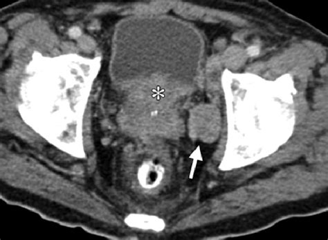 Axial Ct Scan Of The Pelvis Shows Multiple Enlarged Lymph Nodes Seen