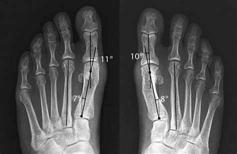 A Comparison Of Proximal And Distal Chevron Osteotomy Both With