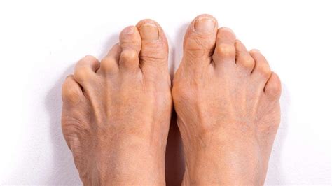 Rheumatoid Arthritis Symptoms Causes And Treatment The Feet People Podiatry