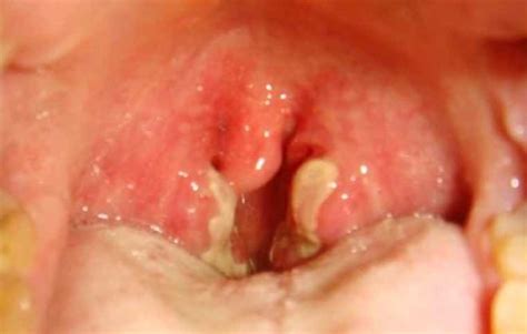 White Spots On Tonsils Pictures Causes And Treatment