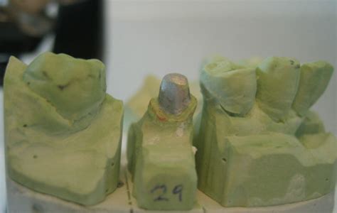 With the advent of dental bonding technologies, we can be more conservative than ever when preparing a tooth for a crown. Crown (dentistry) - wikidoc