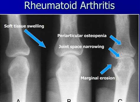 Rheumatoid arthritis is a chronic, inflammatory synovial joint disorder characterized by symmetrical polyarticular arthritis, and commonly affects the hands, wrists, and inflammatory markers and other laboratory abnormalities. rheumatoid arthritis | Rheumatology and X-ray | Pinterest ...