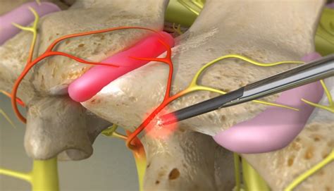 Radiofrequency Ablation Rfa Neurotomy In The Cervical Spine
