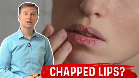 Which Vitamin Deficiency Causes Chapped Cracked Lips Dr Berg Youtube