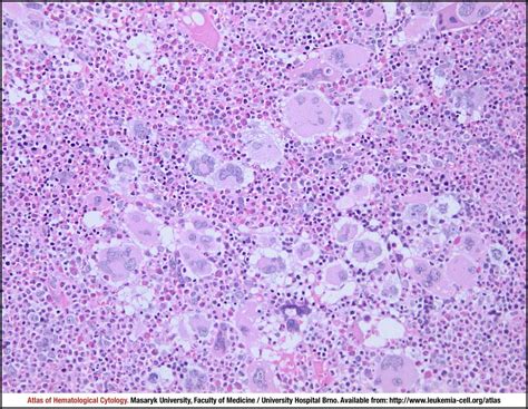 Prefibroticearly Primary Myelofibrosis Cell Atlas Of