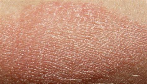 10 Common Psoriasis Symptoms And Signs New Life Ticket Part 3