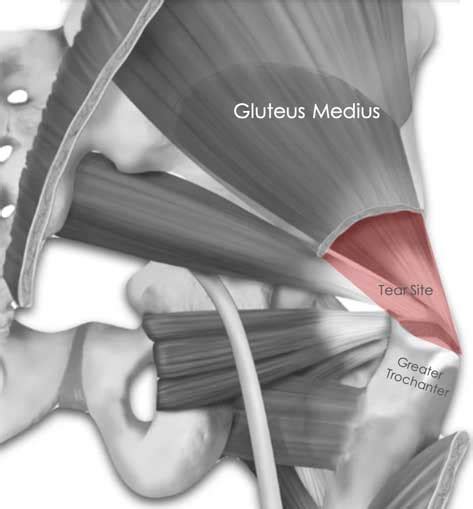 Gluteus Medius Tears Faqs Chicago Il Dr Jorge Chahla