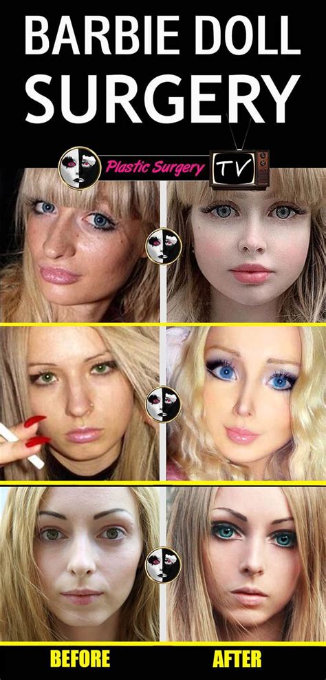 barbie doll plastic surgery before and after in 2022 plastic surgery lip plastic surgery