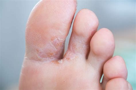 4 Skin Conditions That Cause Itchy Feet