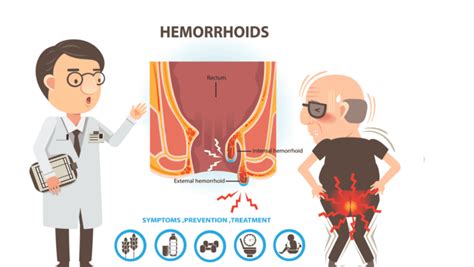Hemorrhoid Help Taking Care Of Your Comfort