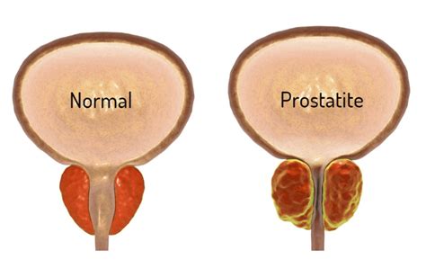 Prostatite O Que é Quais Os Sintomas E Como é Feito O Tratamento