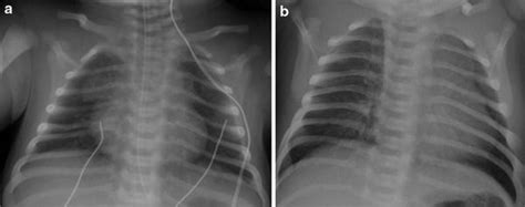 Of The Pediatric Thymus And Thymic Disorders Radiology Key