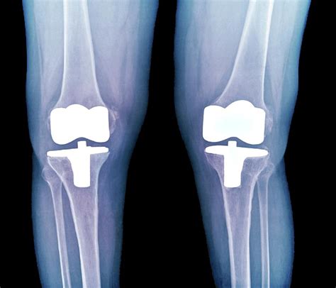 Bilateral Total Knee Replacement Photograph By Zephyrscience Photo Library