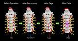 Nerve Recovery After Acdf Images