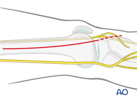 Lateralanterolateral Approach To The Distal Femur