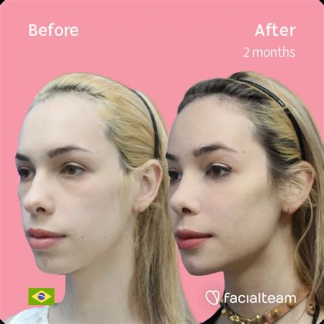 Julia R Before And After Ffs Surgery — Facialteam