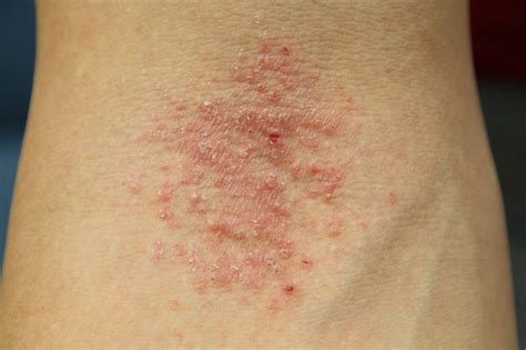 Should I See A Dermatologist Or Allergist For My Rash Massachusetts