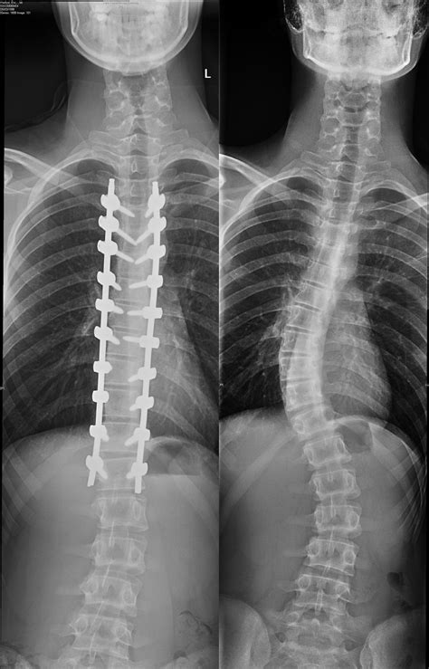 Scoliosis X Ray With Rods