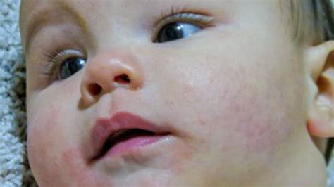 Dermatita Atopica La Copil Cauze Si Cum Se Trateaza Sfatul Medicului