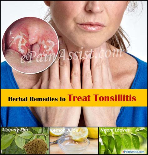 Herbal Remedies To Treat Tonsillitis