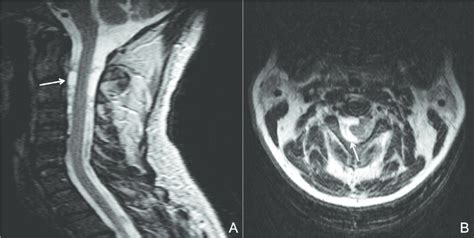 Spinal Cysts A Spinal Cyst Arrows At The Cervical Level In A Patient