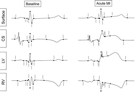 Representative Body‐surface And Intracardiac Electrocardiographic Beats