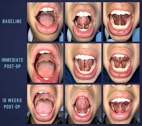 Tongue Ties Whats A Functional Frenuloplasty Myofunctional