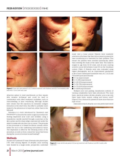 Atrophic Acne Scarring And Dermal Filling