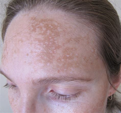 Albums 96 Pictures Pictures Of Tinea Versicolor On Face Updated