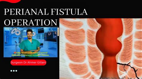 Perianal Fistula Operation Fistulectomy And Fistulotomy Nle Drrkmishra Youtube
