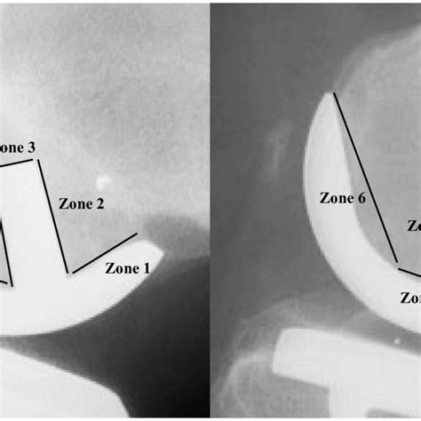 Radiolucent Lines Zone For Single Peg And Twin Peg Femoral Components